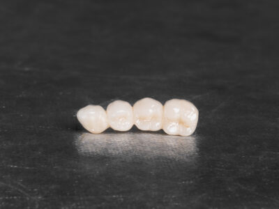 Metal ceramic bridge on implants